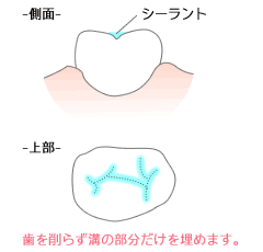 シーラントの断面図