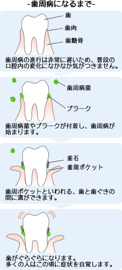 歯周病になるまで